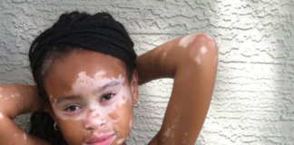 Meu filho tem vitiligo, e agora?