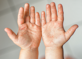 Mão-pé-boca: doença viral que acomete crianças de até 5 anos