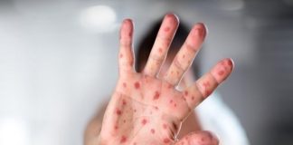 Síndrome mão-pé-boca: tudo o que você precisa saber