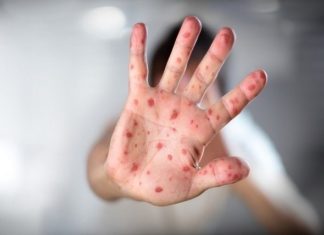 Síndrome mão-pé-boca: tudo o que você precisa saber