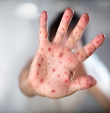 Síndrome mão-pé-boca: tudo o que você precisa saber