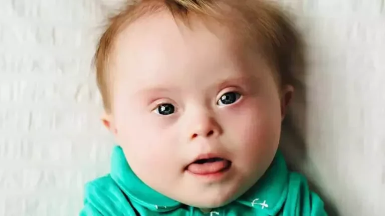 Síndrome de Down: primeiros cuidados com os bebês